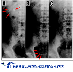 図26-1　体外結石破砕治療経過の時系列的なX線写真