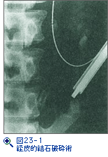 図23-1　経皮的結石破砕術