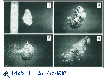 図25-1　腎結石の破砕